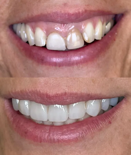 Sonrisa antes y después de una rehabilitación realizada con Odontotecnia